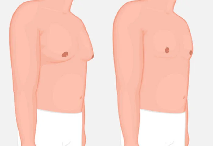 More men turn to docs as man boobs affect mental health